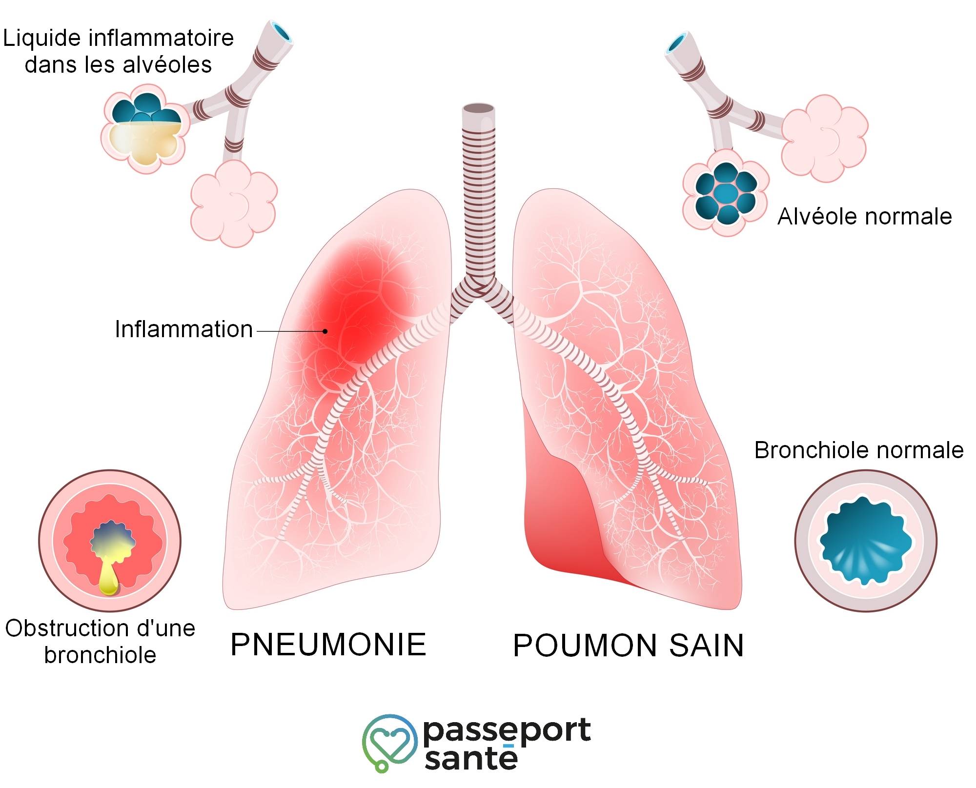 Coronavirus : ce sont les symptômes de la pneumonie causée par le covid-19